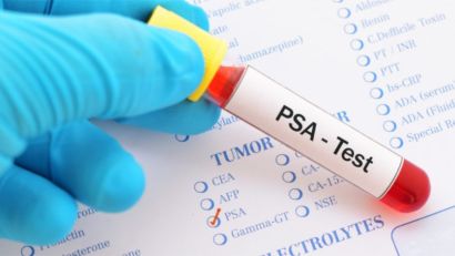 SOCIEDADE BRASILEIRA DE UROLOGIA ALERTA PARA O AUMENTO DE CASOS DE CÂNCER DE PRÓSTATA
